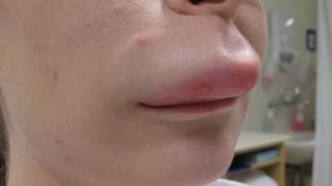 Frau hat geschwollene Lippe. So etwas haben die Ärzte noch nie gesehen!