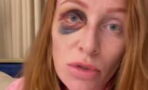 Wer steckt hinter Georgina Fleurs blauem Auge? "Ich wurde brutal zusammengeschlagen"