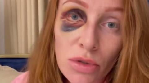 Wer steckt hinter Georgina Fleurs blauem Auge? "Ich wurde brutal zusammengeschlagen"