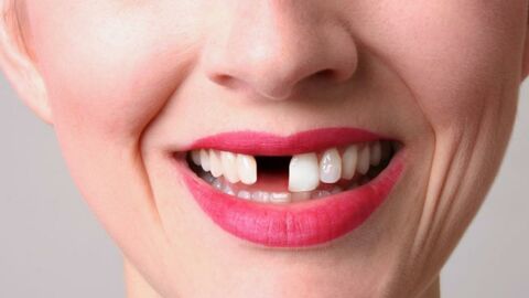 Gebiss: Eine revolutionäre Behandlung lässt Zähne "wachsen"