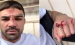 UFC : Tête ensanglantée, phalanges brisées, Mike Perry va quand même combattre le week-end prochain