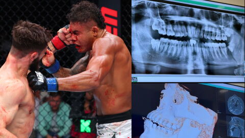 La blessure terrifiante d’un combattant de l’UFC après sa défaite par KO