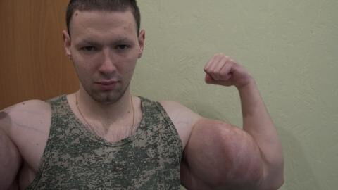 Synthol Kid : le Popeye russe aux bras musclés opéré une deuxième fois, il montre les images
