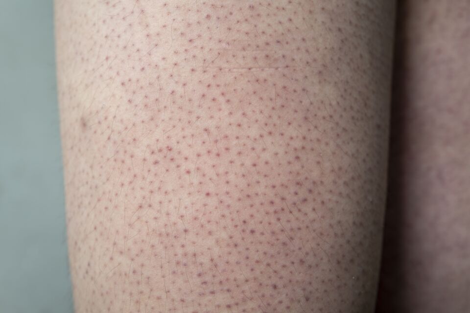 Keratosis pilaris: This is what causes those little red dots on your skin