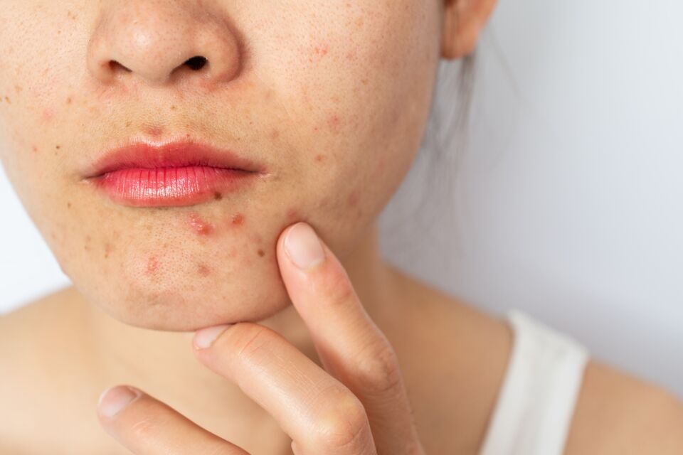 genital-pimples-or-herpes-here-s-how-to-tell-the-difference