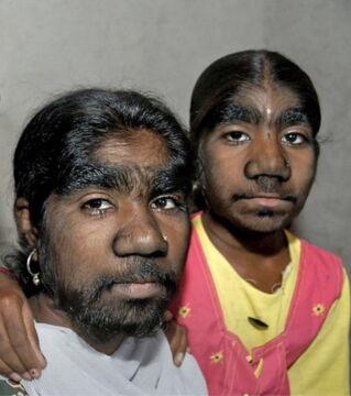 The Sangli Sisters of India are the hairiest women in the world. They have a rare disease commonly known as Werewolf Syndrome.