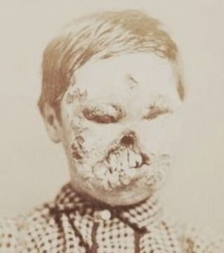 Zombies - In Italy during the Renaissance a syphilis epidemic caused several people’s bodies to be deformed. Symptoms that will definitely make you believe monsters exist…