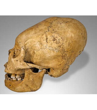 Bei manchen Völkern, wie den Burgundern, den Hunnen oder auch in Asien wurden den Säuglingen und Kindern aus ästhetischen Gründen durch Bandagieren bis zur Pubertät die Schädel verformt.