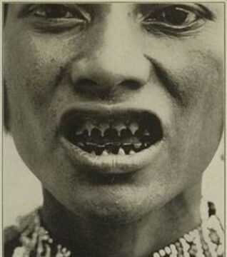 Beim philippinischen Volk der Bagobo werden die Zähne spitz gefeilt. Aus spirituellen Gründen, als Zeichen der Hierarchien und auch zum Nachahmen von Tieren.