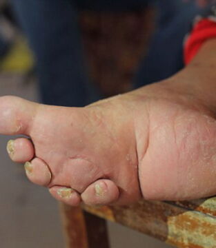 In China wurden den Mädchen mancher Gesellschaftsschichten ab dem frühen Kindesalter die Füße eingebunden, um ihnen die Form einer Lotusknospe zu geben.