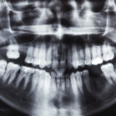 6. Die Weisheitszähne bei heranwachsenden Menschen