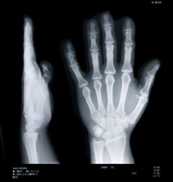 Ein Problem nur für extreme Kletterer und Alpinisten