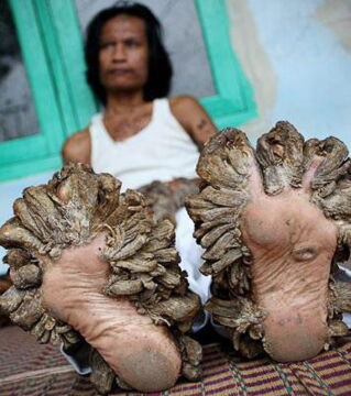 "Baum-Menschen"-Krankheit: Eine Mutation, bei der Warzen wachsen, die sich stark weiterentwickeln und der Rinde eines Baums ähneln