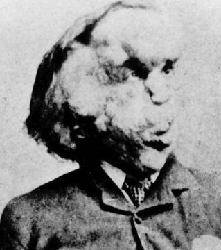 Elefantiasis: Abnorme Vergrößerung eines Körperteils