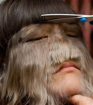 Hypertrichose oder Wolfsmensch-Krankheit: Bei Betroffenen können bis zu 98 % des Körpers behaart sein