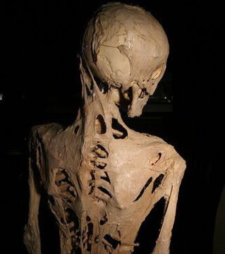 Münchmeyer-Syndrom: Das Muskelgewebe verknöchert und wird so hart wie Stein