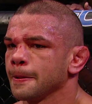 Thiago Alves Nase musste nach einem Ellenbogenstoß von Carlos Condit während er UFC Fight Night 67 dran glauben