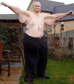 Nach einer drastischen Diät will der Brite Paul Mason, ehemals dickster Mann der Welt, dass ihm rund 10kg Haut entfernt werden