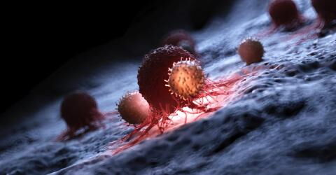 Gründe für einen kratzenden Hals: Krebserkrankung