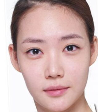 Before: CC cream means colour control. It is ideal for those who have sensitive skin with small red patches.