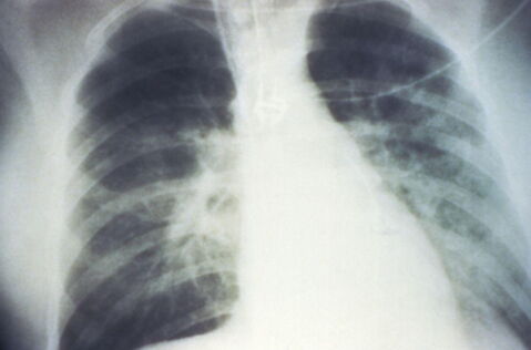 Entfernen der kranken Lunge